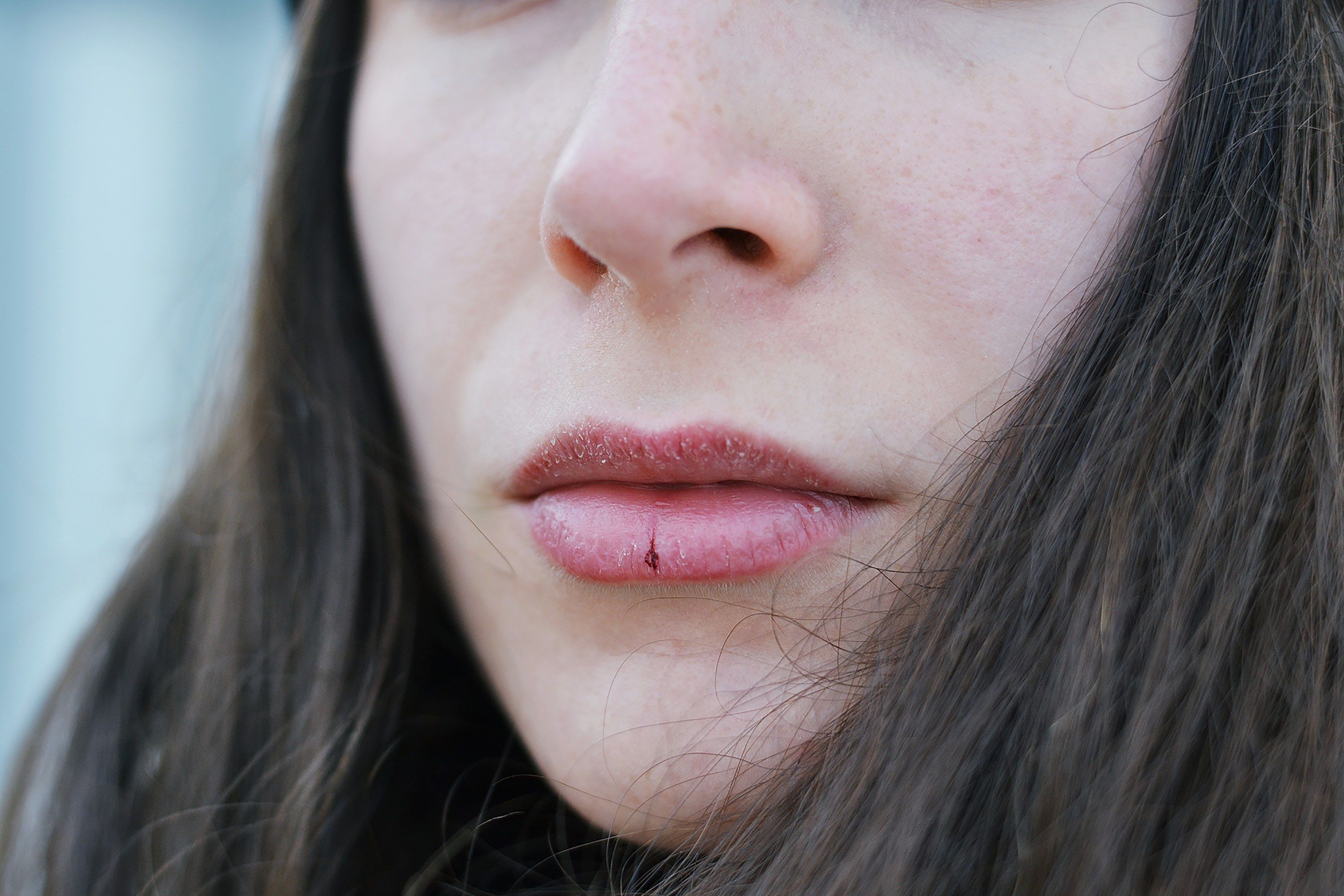 How to Avoid Chapped Lips This Winter, According to Dermatologists Like It ...